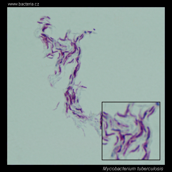 mycobacterium tuberculosis cording under the microscope