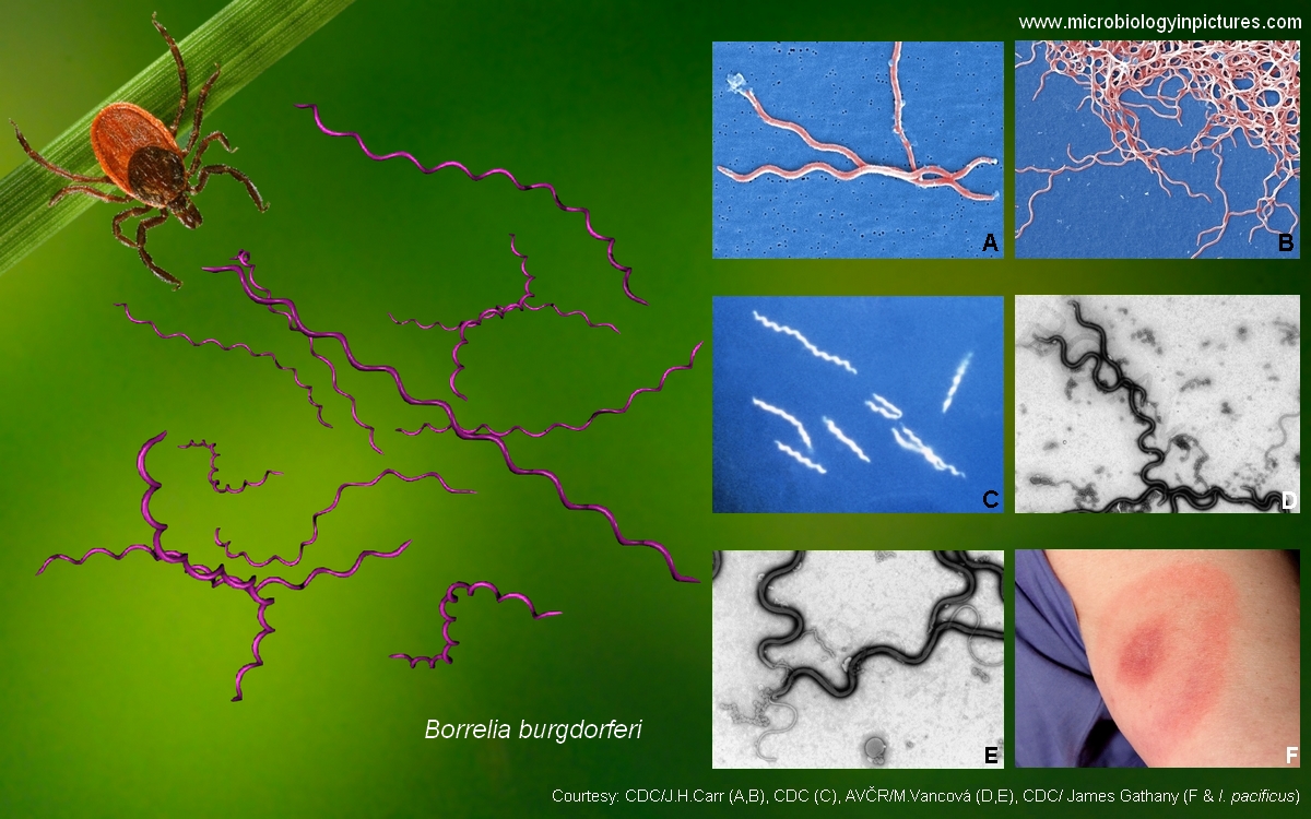Borrelia burgdorferi pictures