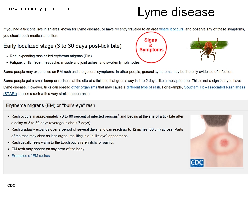 early stage of borreliosis