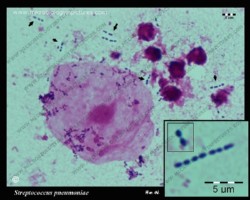 streptococcus pneumoniae in sputum; micrograph