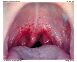 strep throat