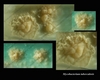tuberculosis