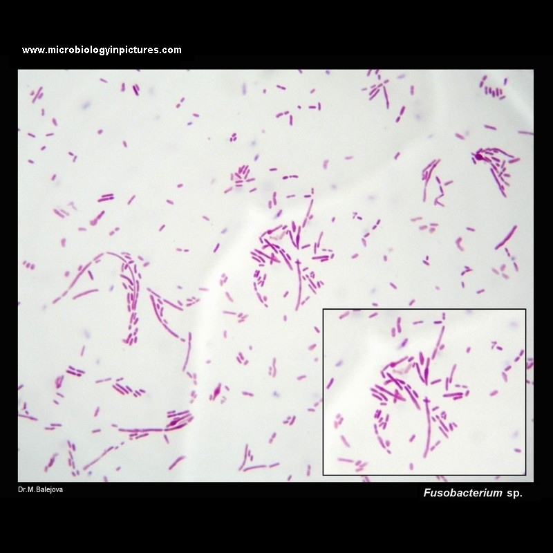 fusobacterium