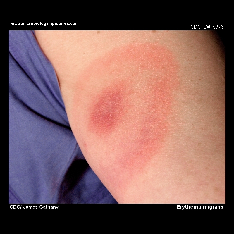 erythema migrans