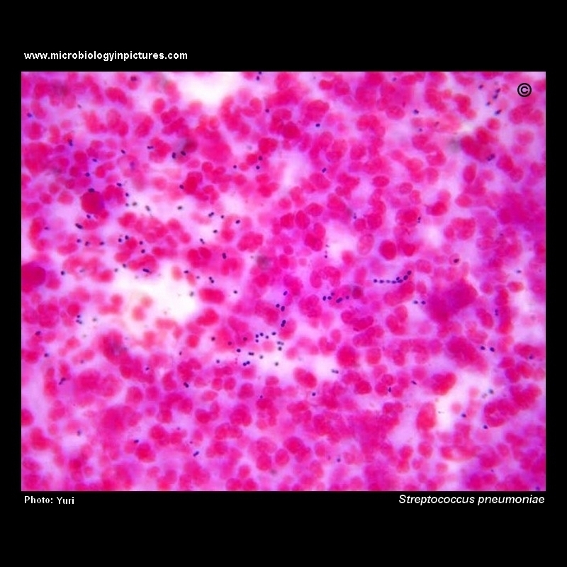 Streptococcus pneumoniae in CSF
