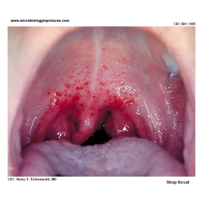 strep throat
