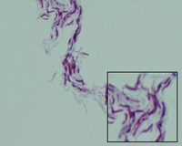 mycobacterium tuberculosis Ziehl-Neelsen stain, cording cells
