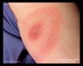 bull's eye rash