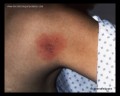 erythema migrans, EM rash