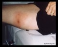 erythema migrans, bull's eye rash