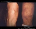 arthritis
